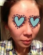 自体脂肪填充后变得更加圆润年轻