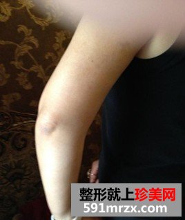 胸部下垂,自体脂肪隆胸