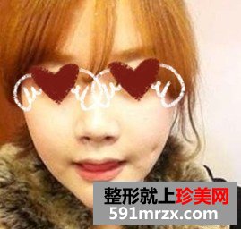 人造酒窝