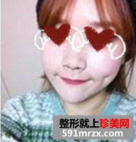 人造酒窝
