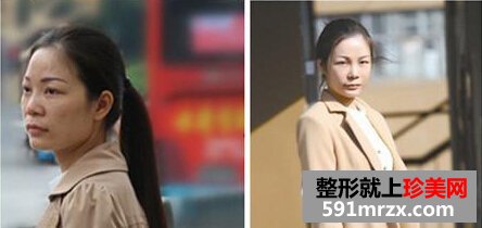 注射式隆鼻,自体脂肪丰苹果肌