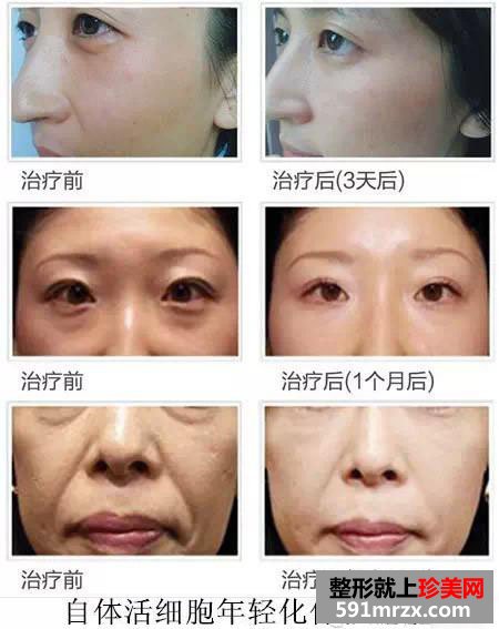自体活细胞,面部,年轻化