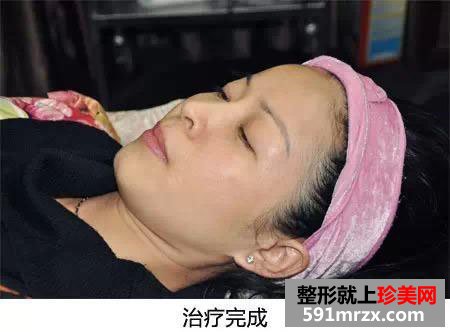 自体活细胞,面部,年轻化