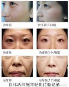 她一下年轻了１０岁，自体活细胞面部年轻化