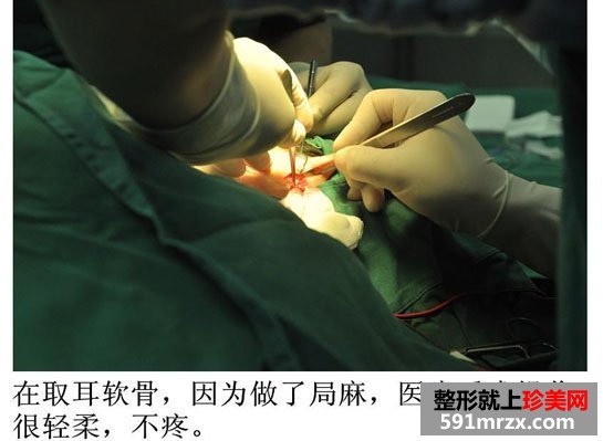 广州,博仕,五官,整形,全过程