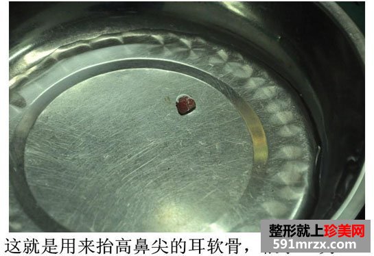 广州,博仕,五官,整形,全过程