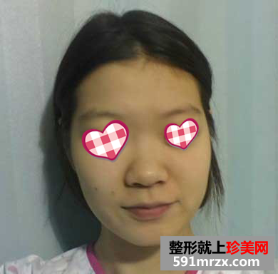 北京,华韩,整形,医院,Misko隆鼻,精致,立体,五官