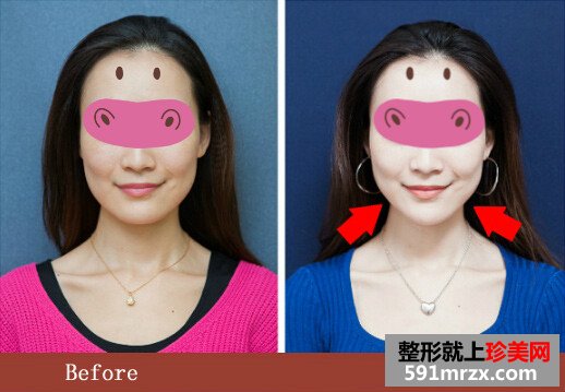 新疆,整形,美容,医院,音波,拉皮