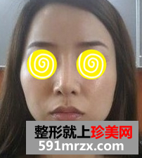 磨骨手术对比照片