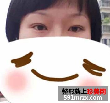 上海,宏康,整形,医院,仿生理,双眼皮