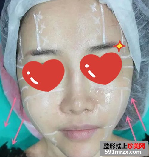 上海,时光,整形,医院,音波,拉皮,非手术,紧肤,新体验
