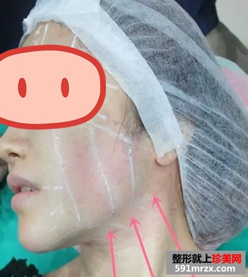 上海,时光,整形,医院,音波,拉皮,非手术,紧肤,新体验