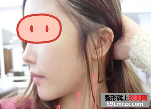 上海,时光,整形,医院,音波,拉皮,非手术,紧肤,新体验