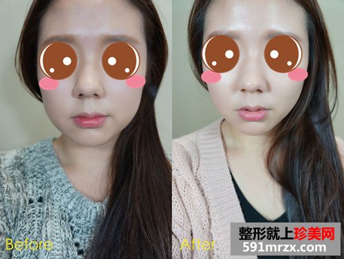 上海,真爱,整形,医院,埋线,提拉,自拍,自信,修图