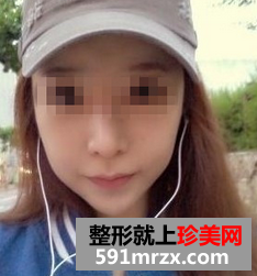 磨骨手术对比照片