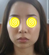 分享磨骨手术前后对比照片终于可以各种自拍了