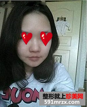 大连,微美,整形,医院,韩式misko隆鼻