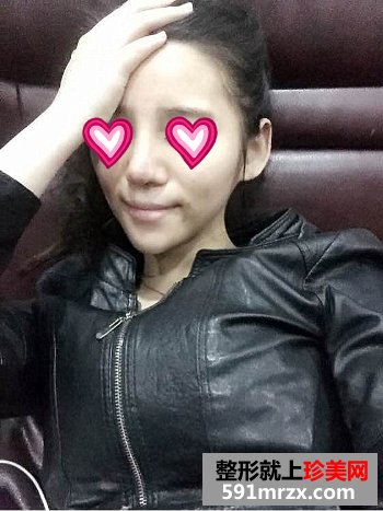 大连,微美,整形,医院,韩式misko隆鼻