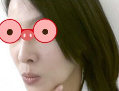 杭州同欣整形美容医院音波拉皮我的瓜子脸又回来了