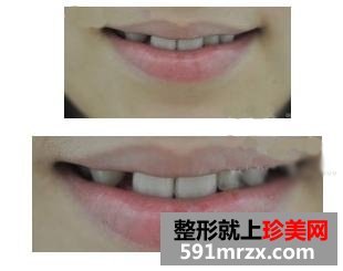宁波,美莱,整形,医院,美容冠,牙齿