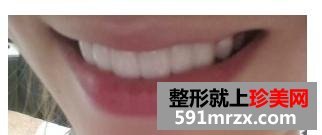 宁波,美莱,整形,医院,美容冠,牙齿