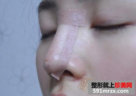 宁波,尚丽,整形,美容,医院,隆鼻,美女,颜值