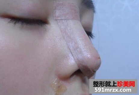 宁波,尚丽,整形,美容,医院,隆鼻,美女,颜值