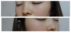 宁波尚丽整形美容医院隆鼻后美女颜值大提升