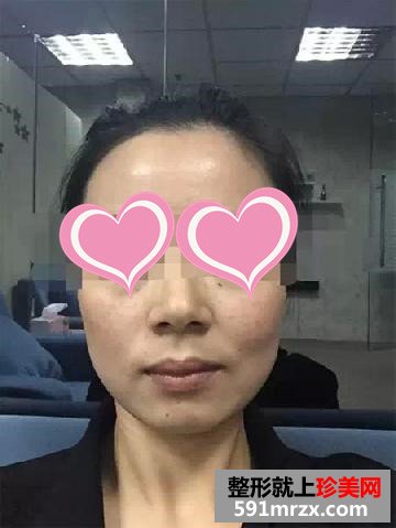 温州,和平,整形,医院,打水光针,70后,女白领,靓肤返龄