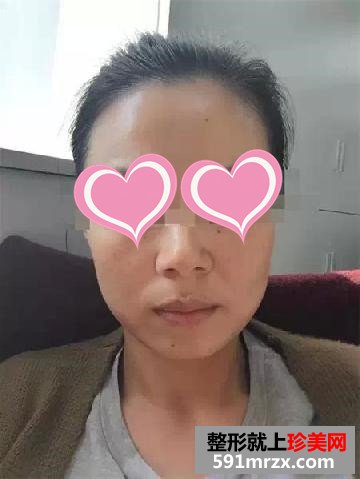温州,和平,整形,医院,打水光针,70后,女白领,靓肤返龄
