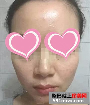 温州,和平,整形,医院,打水光针,70后,女白领,靓肤返龄