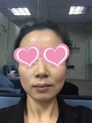 温州和平整形医院打水光针让70后女白领靓肤返龄