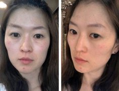 嘉兴曙光整形医院脂肪填充术女网友瞬间变美少女
