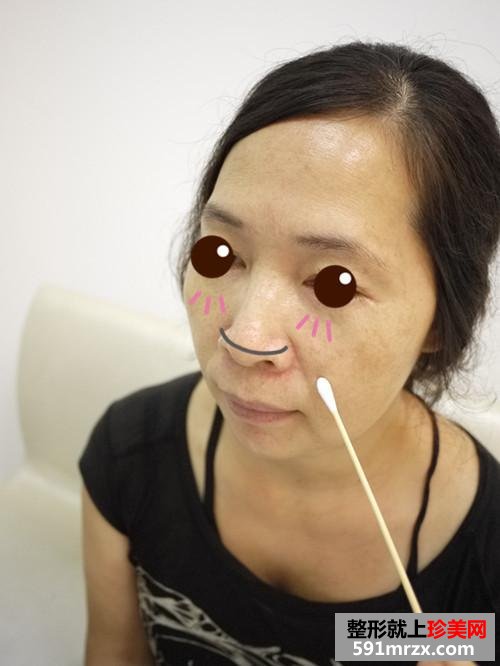 金华,华美,整形,医院,埋线,提拉,10年,青春