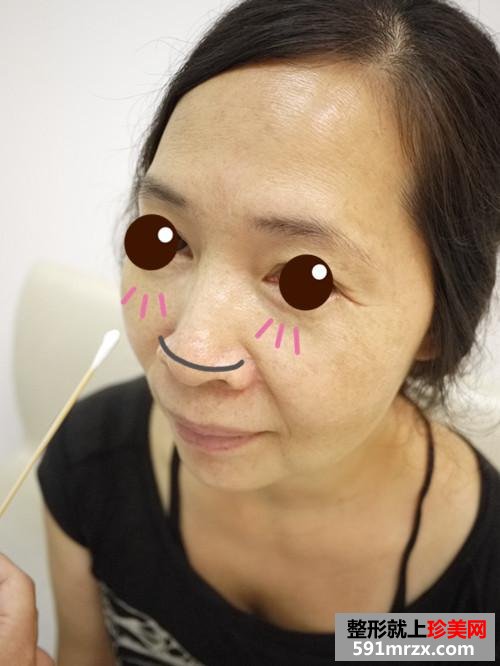 金华,华美,整形,医院,埋线,提拉,10年,青春