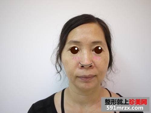 金华,华美,整形,医院,埋线,提拉,10年,青春