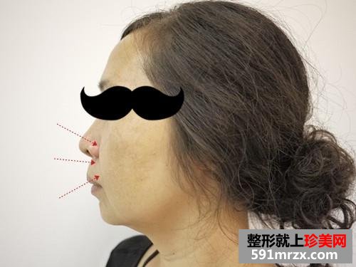 金华,华美,整形,医院,埋线,提拉,10年,青春
