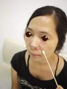 金华华美整形医院埋线提拉还我10年青春