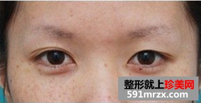 台州,整形,医院,埋线,双眼皮,一单一双