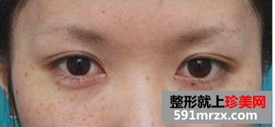 台州,整形,医院,埋线,双眼皮,一单一双