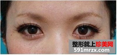台州,整形,医院,埋线,双眼皮,一单一双