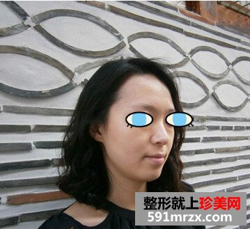 太原,华美,整形,医院,隆鼻,手术,效果,自然
