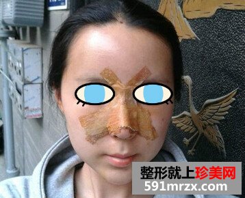 太原,华美,整形,医院,隆鼻,手术,效果,自然