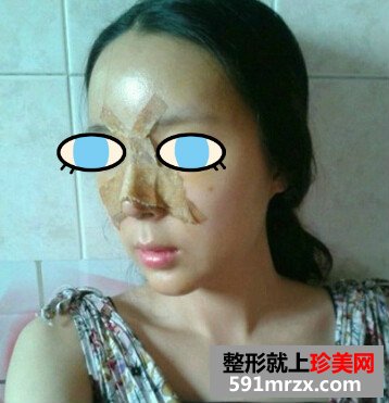 太原,华美,整形,医院,隆鼻,手术,效果,自然