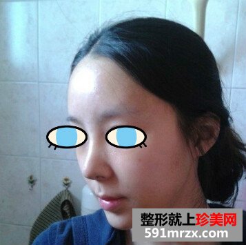 太原,华美,整形,医院,隆鼻,手术,效果,自然