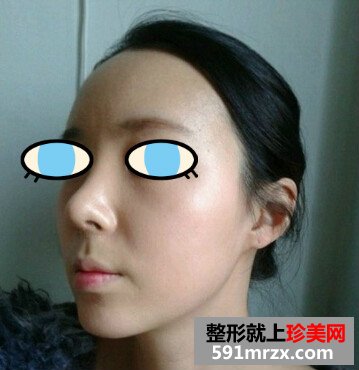太原,华美,整形,医院,隆鼻,手术,效果,自然