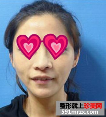 济南,鹏爱,美容,整形,医院,Misko隆鼻,闺蜜,颜值