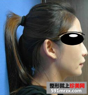 济南,鹏爱,美容,整形,医院,Misko隆鼻,闺蜜,颜值