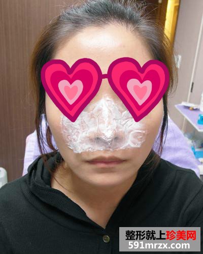 济南,鹏爱,美容,整形,医院,Misko隆鼻,闺蜜,颜值