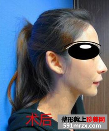 济南,鹏爱,美容,整形,医院,Misko隆鼻,闺蜜,颜值